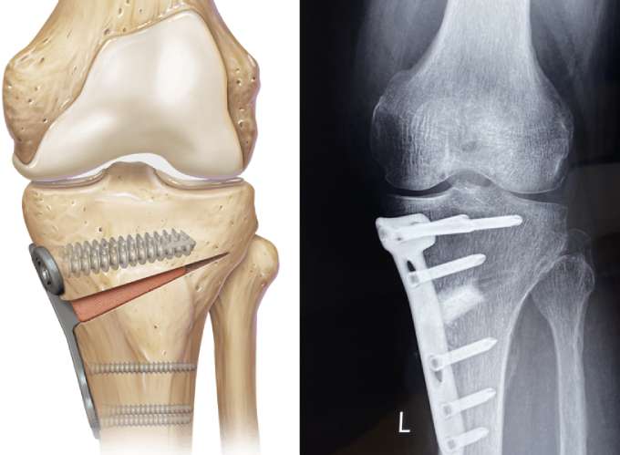 High Tibial Osteotomy Surgery For Knee Pain Relief
